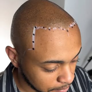 First session results on a natural hairline procedure #hairtattoo #smp #smporlando #orlandosmp