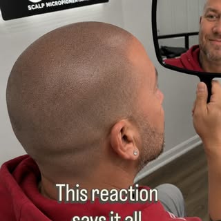 Hair transplant?

Nope.

This is Scalp Micropigmentation (SMP), a non-surgical hair loss solution th