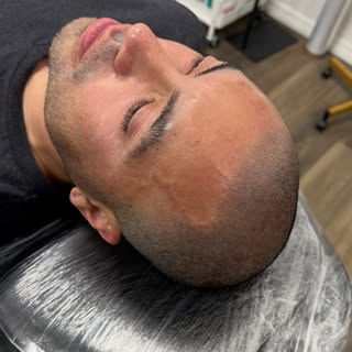 Scalp micropigmentation isn’t about creating a “perfect” hairline — it’s about creating one that act