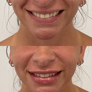 A little filler goes a long way when it’s done right. @injector_mal always focuses on natural result