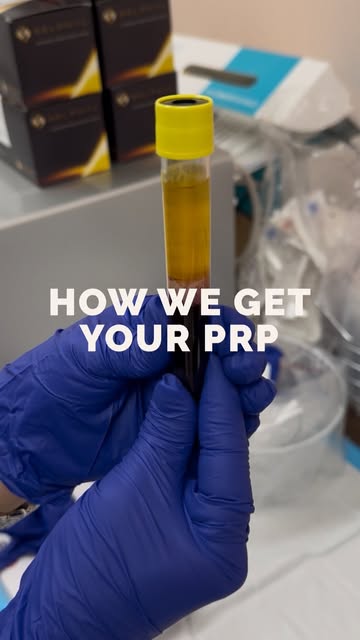 Your PRP comes from you — but how do we actually get it? 🩸

PRP stands for platelet-rich plasma, a 