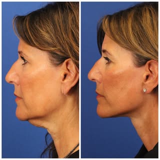 We recently saw our gorgeous patient back 15 months after her deep neck lift and deep plane facelift