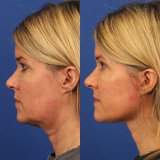 The power of a deep plane facelift and a deep neck lift. 

My gorgeous patient is now just over 1 ye