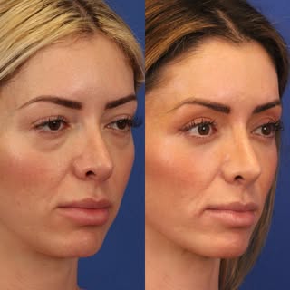 ✨ Natural, refreshed, and never overdone ✨
This beautiful transformation showcases the power of cons