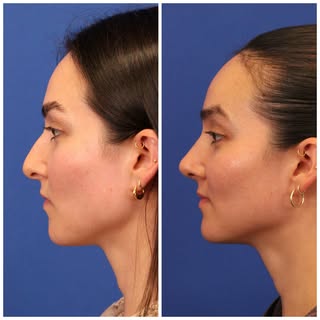 Six weeks after septorhinoplasty and she already has such a beautiful result! 

Her goals were conse