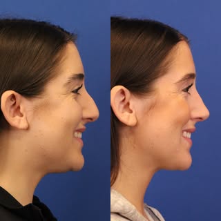 14 months after rhinoplasty, and this is exactly the type of result I love to see! 

Her goals were 