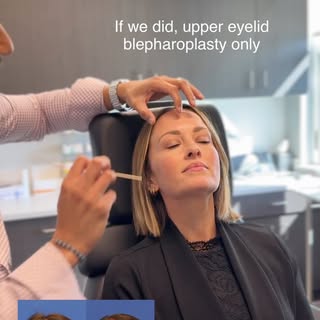 Upper eyelid surgery isn’t always just about the eyelids. 👀

When I evaluate someone for an upper b
