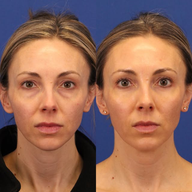 6 months after lower eyelid rejuvenation with no makeup! 

Lower eyelid rejuvenation is much more th