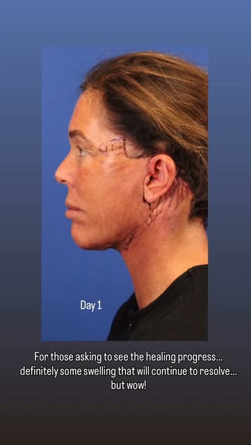 From day 0 to day 13…

On day 1 the neck is very tight and very defined. As swelling increases some 