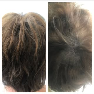 Hairvolume behandeling! Weg met die “ onzekere” plekjes! Info 0624713426