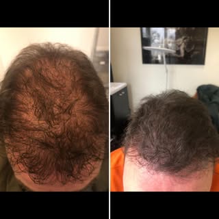 Hoe gaaf!!! Na haartransplantatie, gepigmenteerd, sessie3 ! Voor info , hairtattoo Helmond. nl