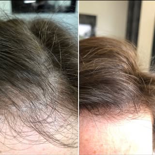 Irriteer jij je ook aan kleine plekjes? App of bel 0624713426 voor intake ! Hairtattoo Helmond