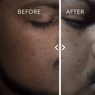 ✨ Just 1 Sitting. And the Results Are Already Visible! ✨

A remarkable improvement in acne-scar text