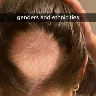 Nutrient deficiency can cause hair loss. #hairlossspecialist #hairlosshalifax #halifaxhairloss