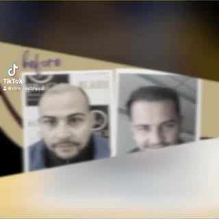 Experience premium hair transplantation at Miracle #hairtransplantation #hairtransformation #drmohan