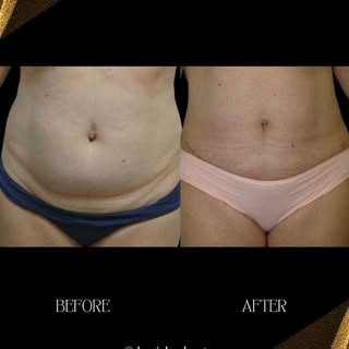 Confidence Starts at the Core ✨

This stunning tummy tuck transformation by Dr. Michael Gartner, dou