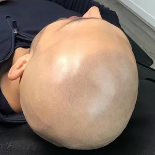 Soft and natural 👌

#skalp #scalpmicropigmentation #SMP #hairtattoo #scalptattoo #hairlinetattoo #h