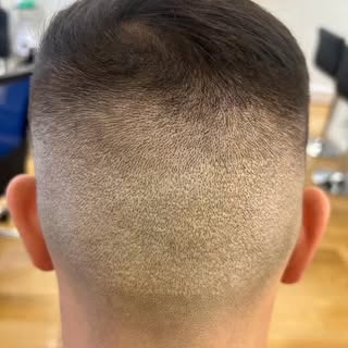About 50% of our clients have scars from failed hair transplants, so we have a lot of experience in 