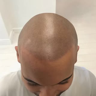 Straight after session 3. Full top of the head coverage with a natural hairline.

Book a free consul