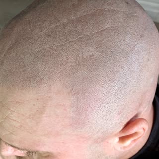 Straight after session 2. Full top of the head treatment.

#skalp #scalpmicropigmentation #SMP #hair