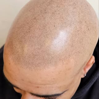 From Session 1 to Session 3… watch Dilesh’s incredible transformation.

With scalp micropigmentation