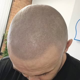 Full top of the head treatment, one month after third session 👌

#skalp #scalpmicropigmentation #SM