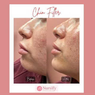 ✨Facial Balancing with JUST 1 Syringe ✨

Less is truly more when it’s done with intention! Our beaut