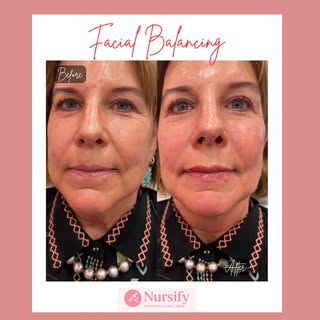 ✨ Facial Balancing = Subtle, Strategic, Stunning ✨

This is your sign that less isn’t always more… b