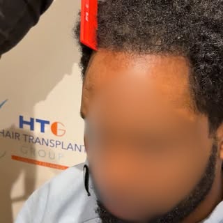 9 months post-hair transplant transformation. This patient looks unrecognisable and has knocked 10 y