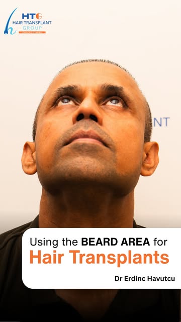 One of the biggest concerns patients have about using the beard as a donor area is scarring.

With c