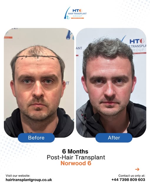 6 months post-hair transplant and already a huge change in coverage and hairline. 👏

This patient c