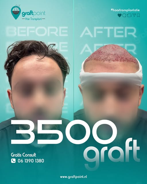 Onze cliënt koos voor een haartransplantatie met 3500 grafts en het verschil is duidelijk zichtbaar.