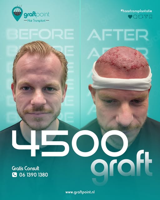 Onze cliënt koos voor een haartransplantatie met 4500 grafts en het verschil is duidelijk zichtbaar.