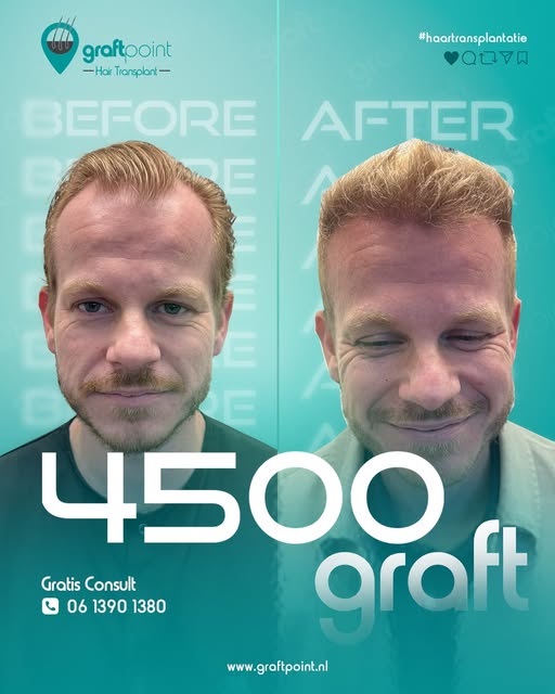 Meer haar. Meer balans. Meer zelfvertrouwen.
Bij GraftPoint helpen we u met een haartransplantatie d