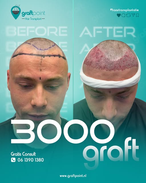 Onze cliënt koos voor een haartransplantatie met 3000 grafts en het verschil is duidelijk zichtbaar.