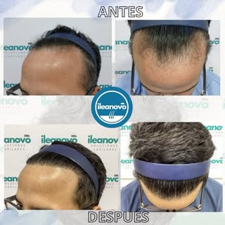 Resultados en implante capilar ✨🇵🇪

#agenda #peru #hairtransformation #hair #like
