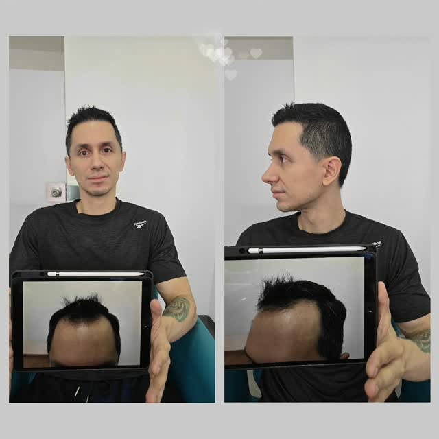 ¿Pensando en recuperar tu cabello este año? 🤔 Mira este cambio real en Cali.

Les compartimos la ev