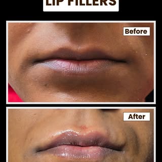 Subtle enhancement, maximum confidence. ✨ Check out this amazing lip filler transformation! We achie
