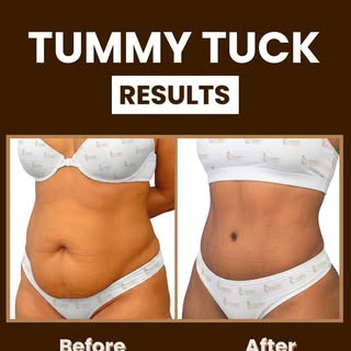 More Than a Tummy Tuck - A Transformation in Form, Function & Confidence. ✨

A tummy tuck (abdominop