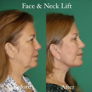 Before and 2 months after deep plane #facelift and #necklift surgery. This beautiful 66 year old fem