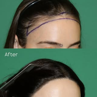 Before and after #hairline and #eyebrow reshaping. This beautiful patient wanted a thicker and more 