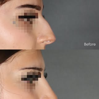 Before & after #rhinoplasty and #septoplasty surgery to reduce a dorsal hump and improve nasal breat