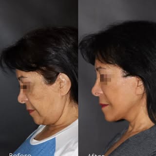 Before & 9 months after revision deep plane Facelift and Neck Lift in a 64-year-old patient. She pre