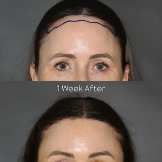 Before & 1 week after a combined Brow Lift and Forehead Reduction Surgery. These procedures can be s