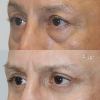 Before & after: upper + lower blepharoplasty with fat grafting

The goal was a refreshed, well-reste