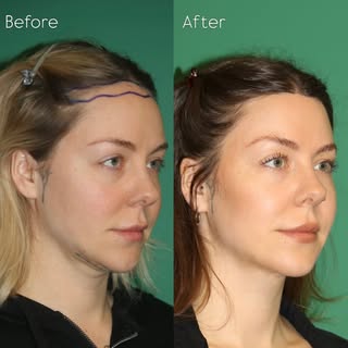 Before and 18 months after Brow Lift & Forehead Reduction Surgery. 

Through a single hairline incis