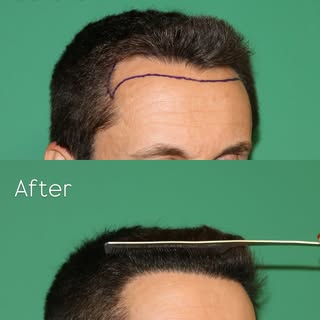 Before & 1 year after FUE hairline restoration.

A total of 2,050 grafts were used to create a natur