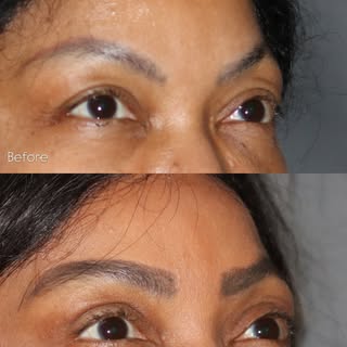 Before & after Upper Eyelid Surgery #blepharoplasty performed in the office under local anesthesia.
