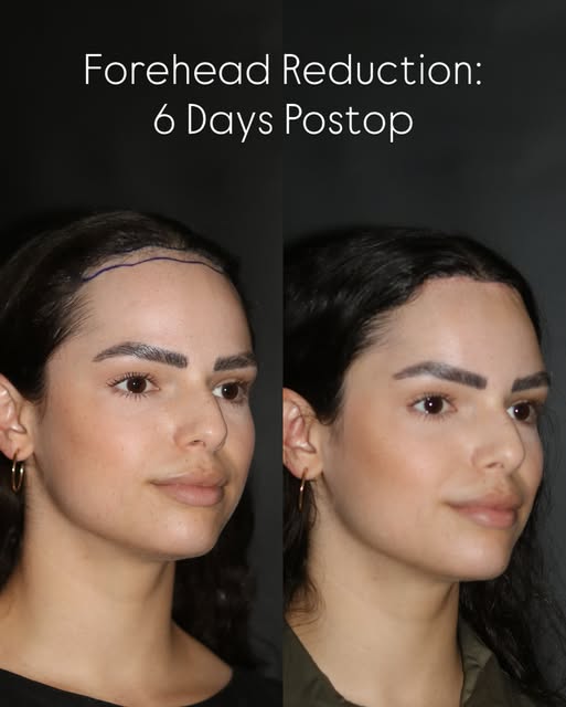 Before & 6 days after Forehead Reduction/ Hairline Lowering Surgery

Often times, the most subtle ch