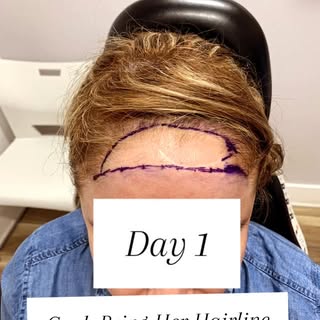 Good afternoon! I completed this #HairTransplant on our lovely patient #2YearsAgo, with the goal of 
